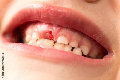 The mouth of a boy without a tooth