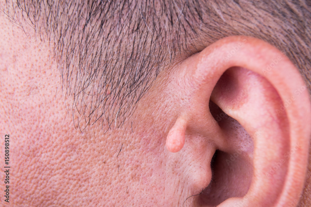 Fototapeta premium Human mutation with extra growth on ear