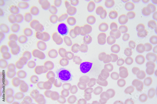 Leukemia cells in blood smear