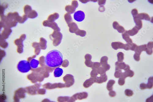 Leukemia cells in blood smear, analyze by microscope 