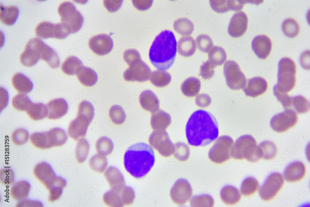 Leukemia cells in blood smear, analyze by microscope

