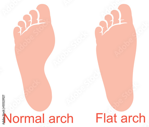 human anatomy - flat and normal arch vector illustration