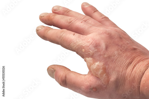 Burns on hand