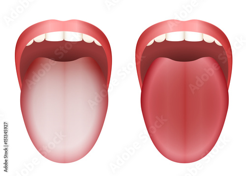 Coated white tongue and clean healthy tongue by comparison - isolated vector illustration on white background.