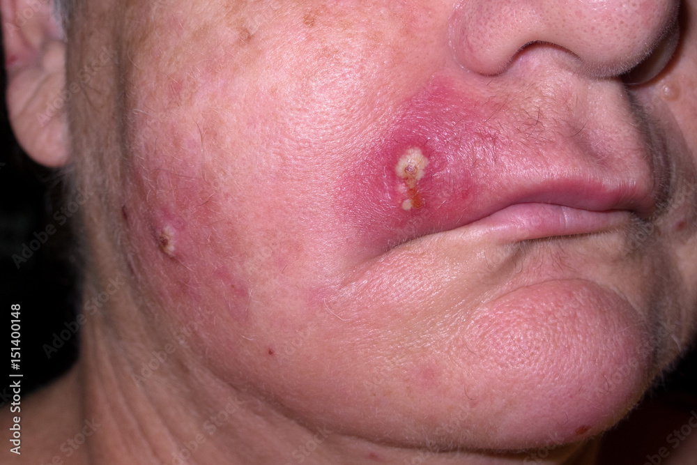 Obraz premium Mature woman with staph infection on face 4