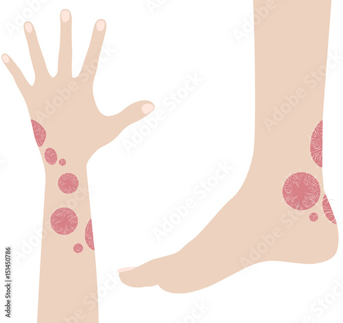 Human hand and leg with psoriasis