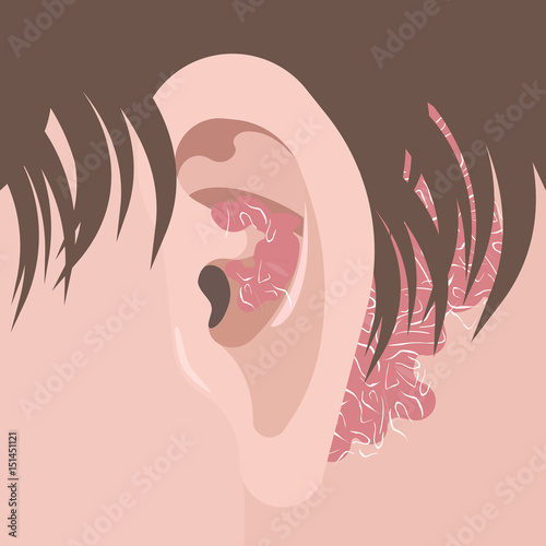 Human neck and ear with psoriasis