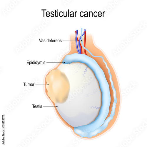 Testicular cancer photo