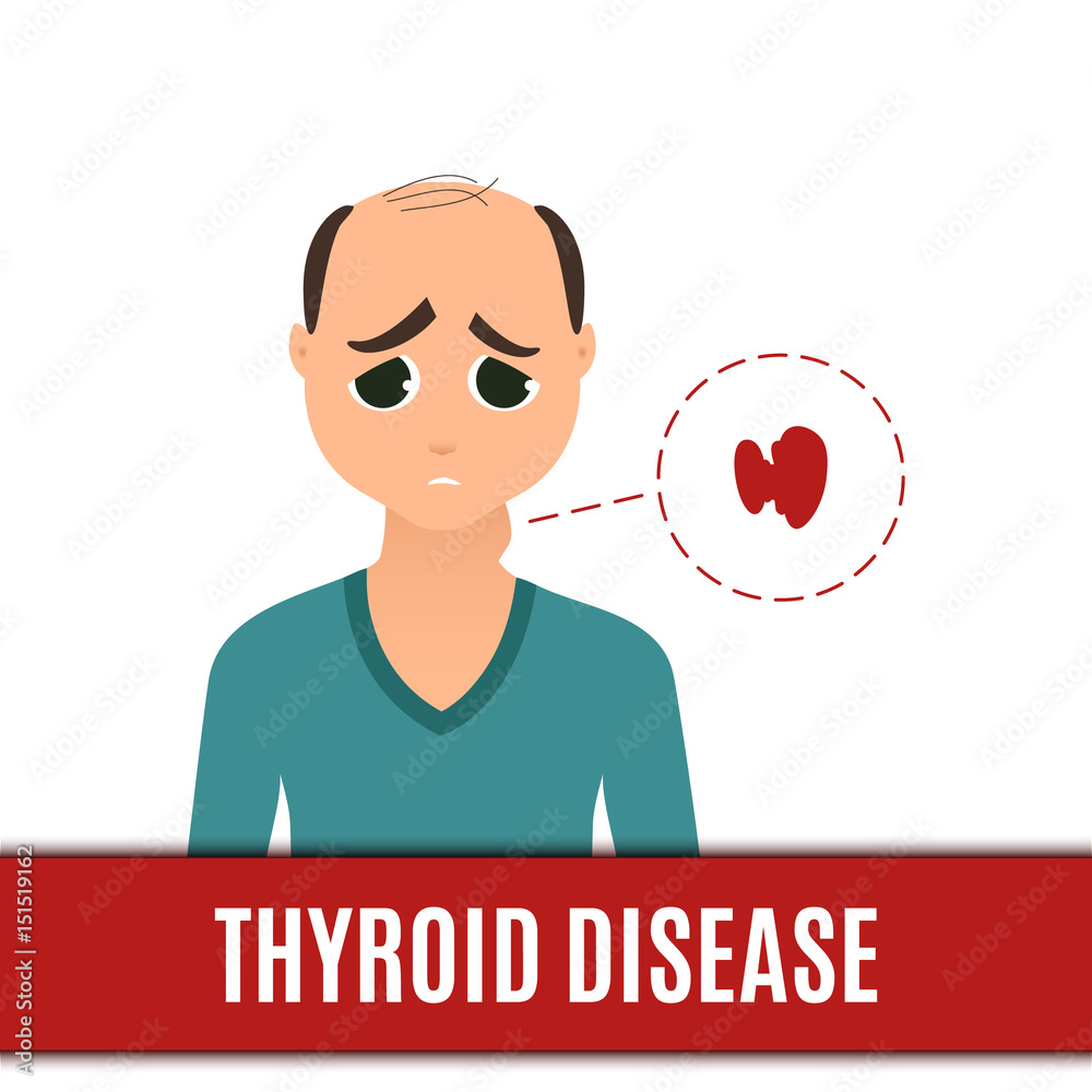 Thyroid gland disorder poster. Man with hyperthyroidism disease and goiter. Body anatomy sign. Human endocrine system. Medical internal organ vector illustration. Thyroid gland disorder poster. Man with hyperthyroidism disease and goiter. Body anatomy sign. Human endocrine system. Medical internal organ vector illustration.