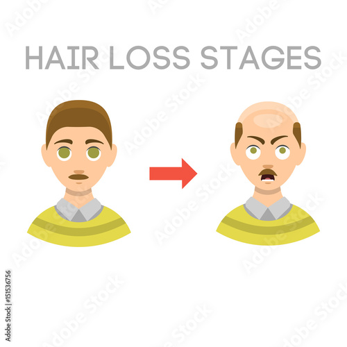 Information chart of hair loss stages types of baldness illustrated on male head vector.
