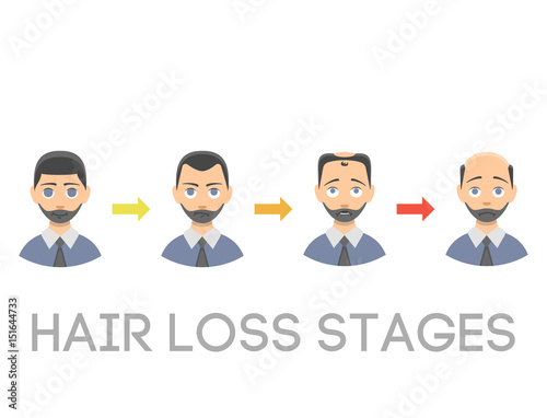 Information chart of hair loss stages types of baldness illustrated on male head vector.