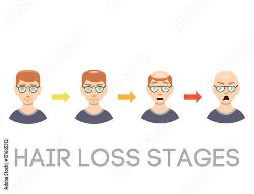 Information chart of hair loss stages types of baldness illustrated on male head vector.