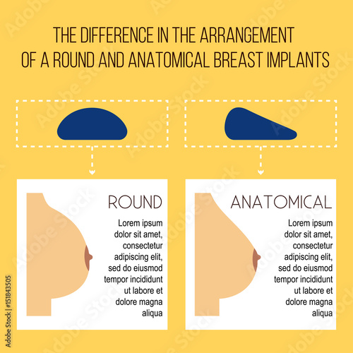 Plastic breast surgery Vector illustration The difference between the installation of round and anatomical breast implants Medical poster in flat design