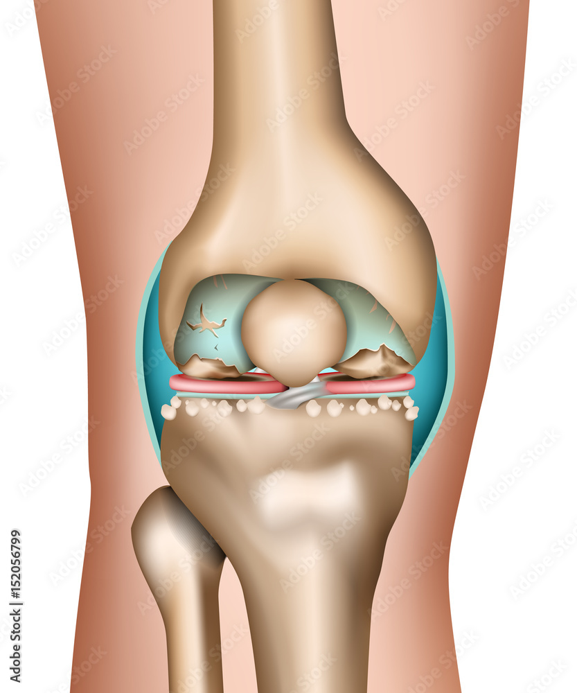 Артроз коленного сустава мениск. Восстановление суставов и хрящей. Артроз коленного сустава.