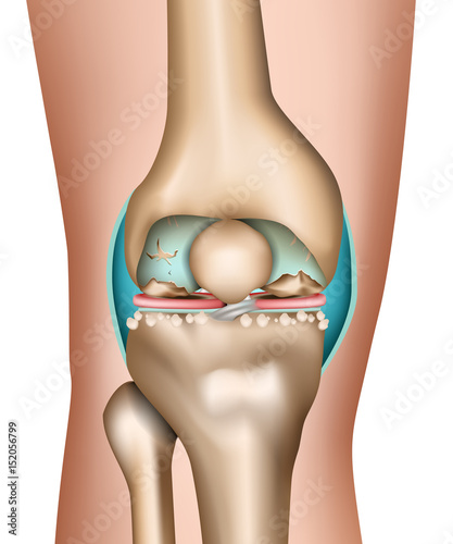 Arthrose im Knie, vector illustration