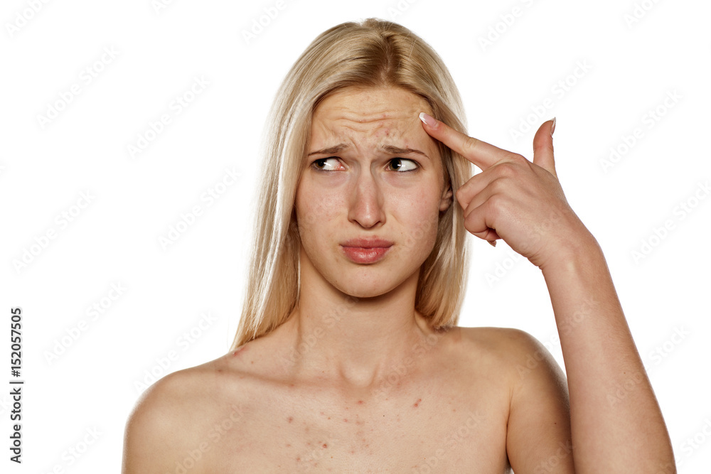 Sad blonde with pimples on her forehead and with a thoughtful look Sad blonde with pimples on her forehead and with a thoughtful look