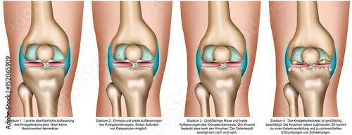 Kniearthrose, Stadien bei Arthrose im Knie, vektor illustration