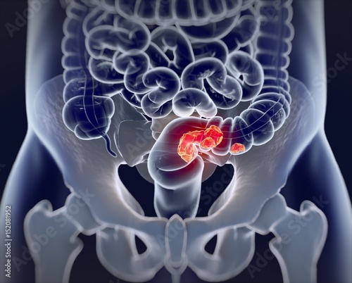 Colorectal cancer,medical illustration.3d illustration