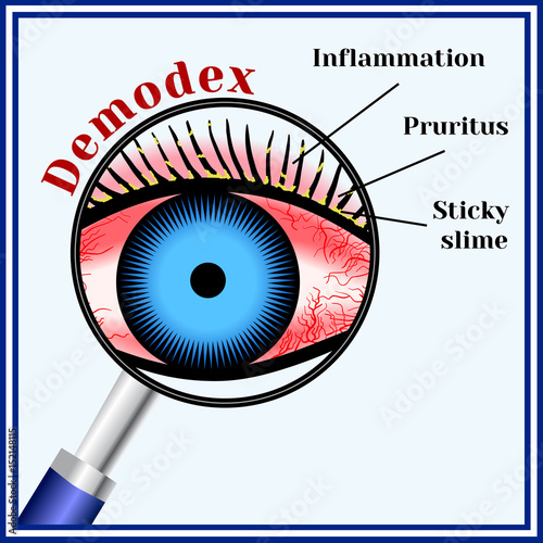 Demodex. Parasitic eye disease.
