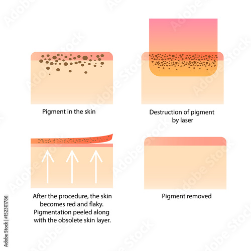 Laser cosmetology. Procedure for removing tattoo, freckles, old dark spots pigment