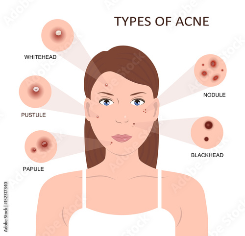 Types of acne. Woman with Pimples