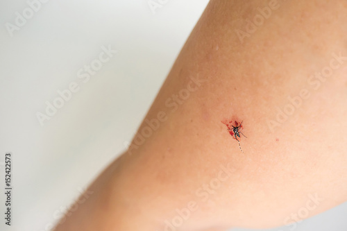 Mosquito death on woman arm. After hit by her palm.