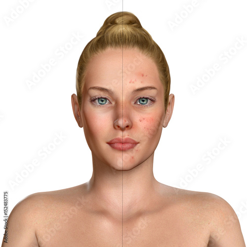 3d illustration of a woman before and after acne treatment procedure