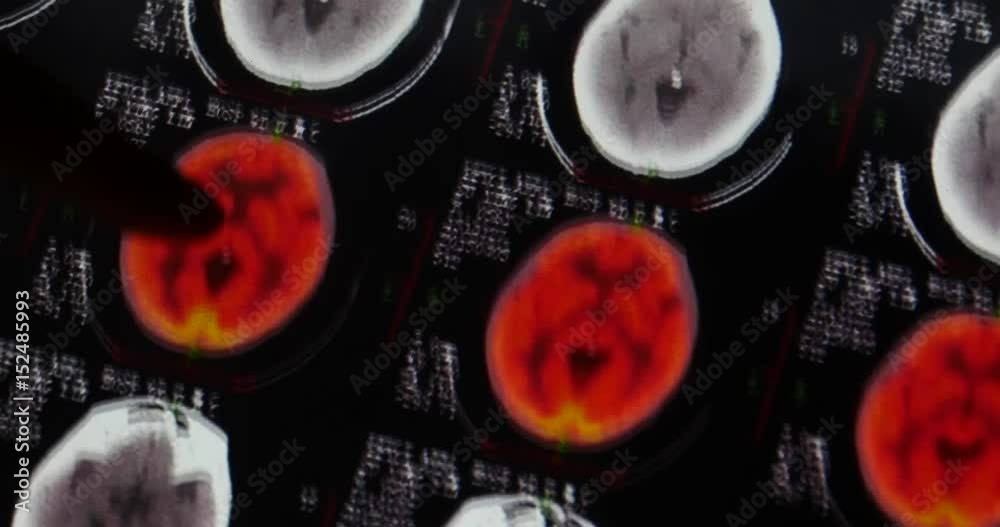 4k Doctor study head pet-ct skull brain scan X-ray film for analysis ...
