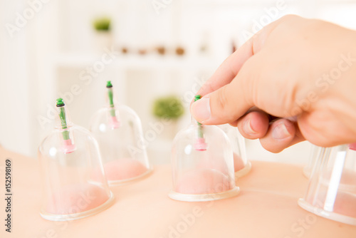 Cupping therapy spa woman removes