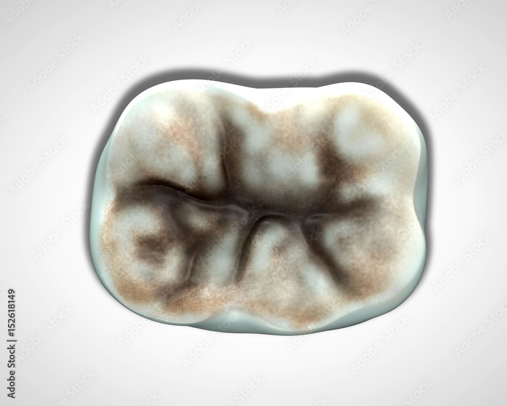 Naklejka premium 3d rendering - decay in molar teeth