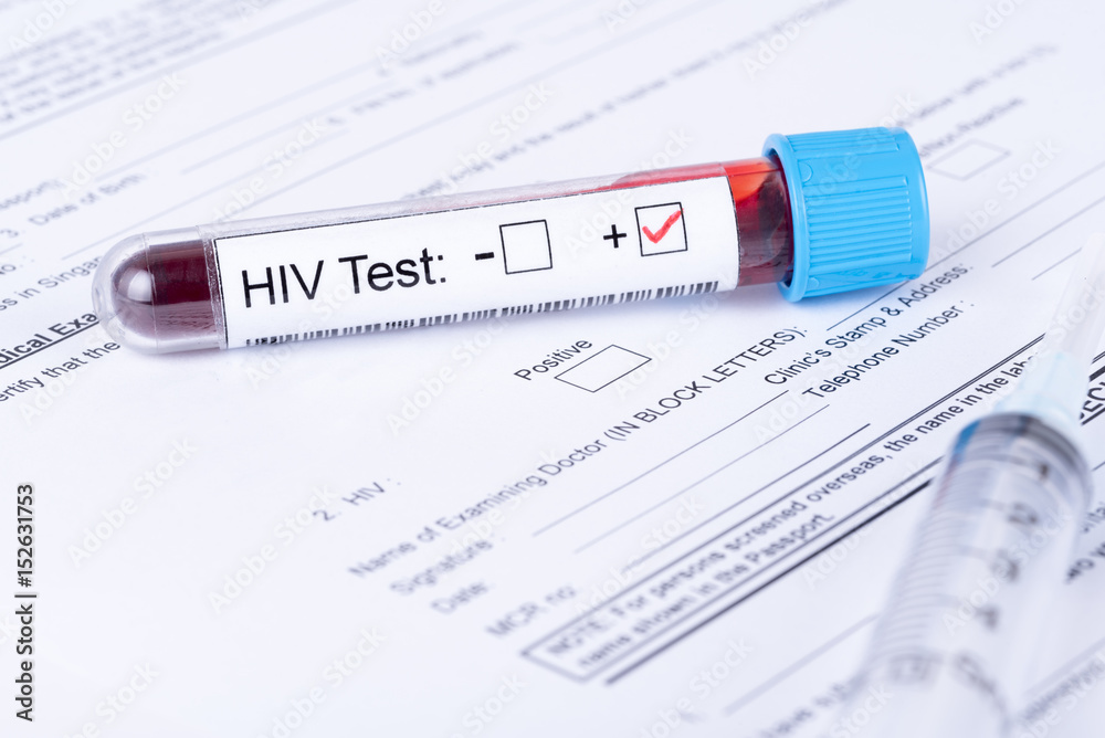 HIV positive test sample with medical forms HIV positive test sample with medical forms