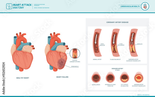 Anatomy of a heart attack