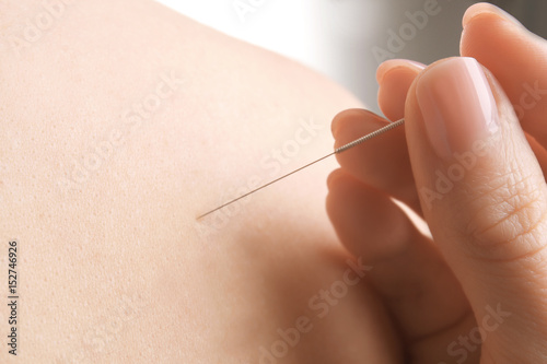 Woman stimulating acupuncture points on patient's back, closeup
