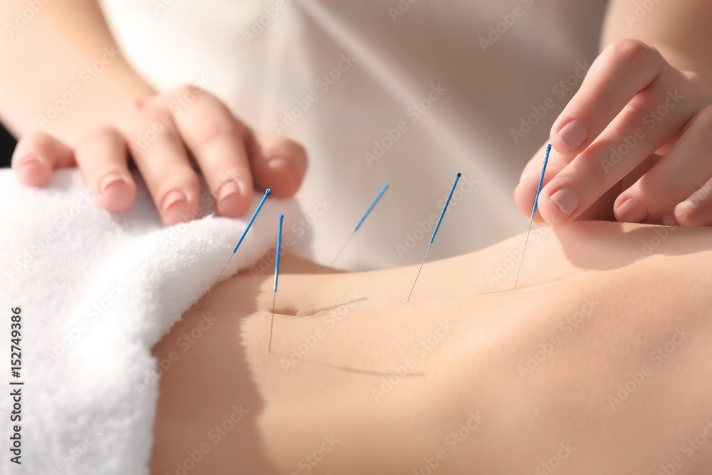 Young woman undergoing acupuncture treatment, closeup - obrazy, fototapety, plakaty 