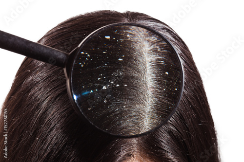 The doctor looks through a magnifying glass at the dandruff on dark female hair photo