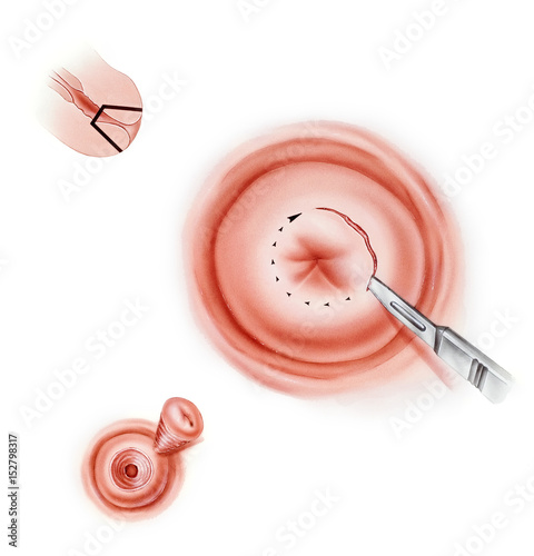 Conization (cone biopsy or cold knife cone biopsy) of the cervix, a procedure used to detect and treat abnormalities of the cervix.