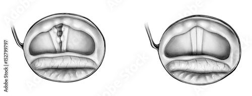 Human epiglottis (left) and a vocal abused epiglottis with callus like nodules (right). photo