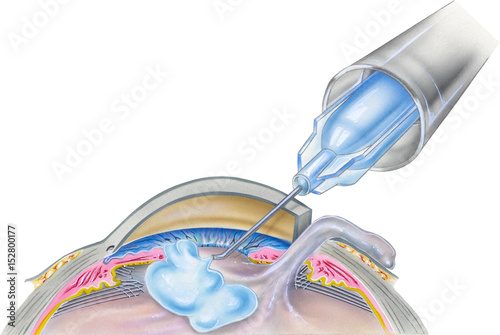 Step 3 of 7. A cataract is an eye disease in which the normally clear lens of the eye becomes cloudy or opaque, causing a decrease in vision.