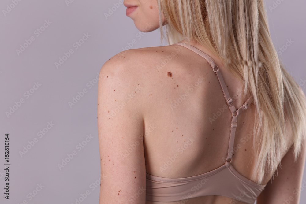 Naklejka premium Checking benign moles : Beautifull Woman with birthmarks on her back and face. Laser skin tags removal