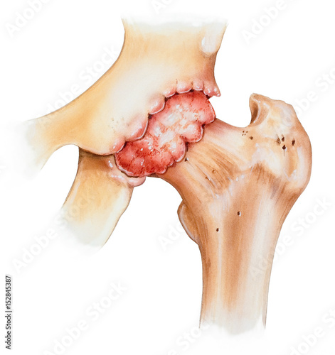 Osteoarthritis of a hip joint, front view. photo