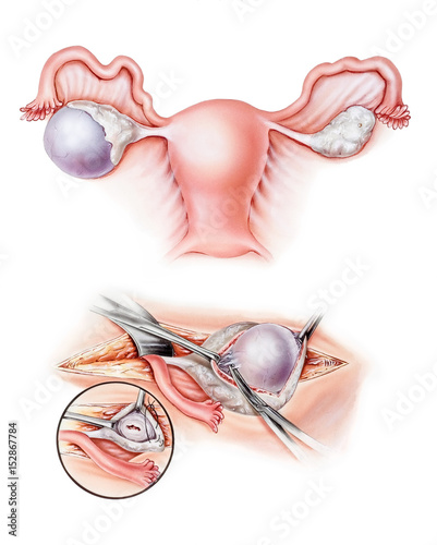 An ovarian cystectomy, a surgery to remove an ovarian cyst.