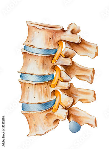 Spine - Nerve Irritation caused by bone overgrowth in a section of the spine. Bone spurs are putting pressure on spinal root nerves on the dorsal side of the spine... photo