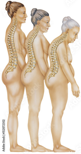 The progression of osteoporosis and vertebral fractures as a woman ages.