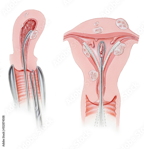Uterus - Dilation and Curettage (DandC) Procedure photo