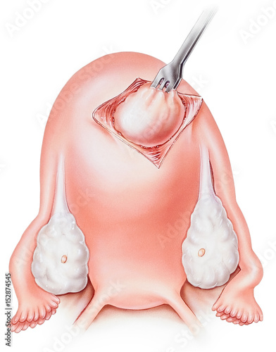 Uterus - Fibroid Removal - Myomectomy photo