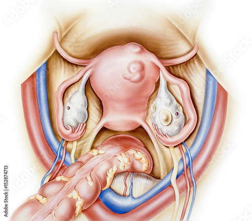 Uterus and Ovaries. A normal ovary (left) and an ovary with small ovarian cysts (right). Also shown are a normal uterus (left) and a uterus with fibroids (right). .