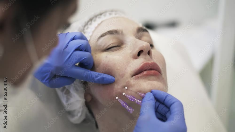 Beautician inserting needles under the skin of a woman lying in bed. Handheld real time close up shot Beautician inserting needles under the skin of a woman lying in bed. Handheld real time close up shot