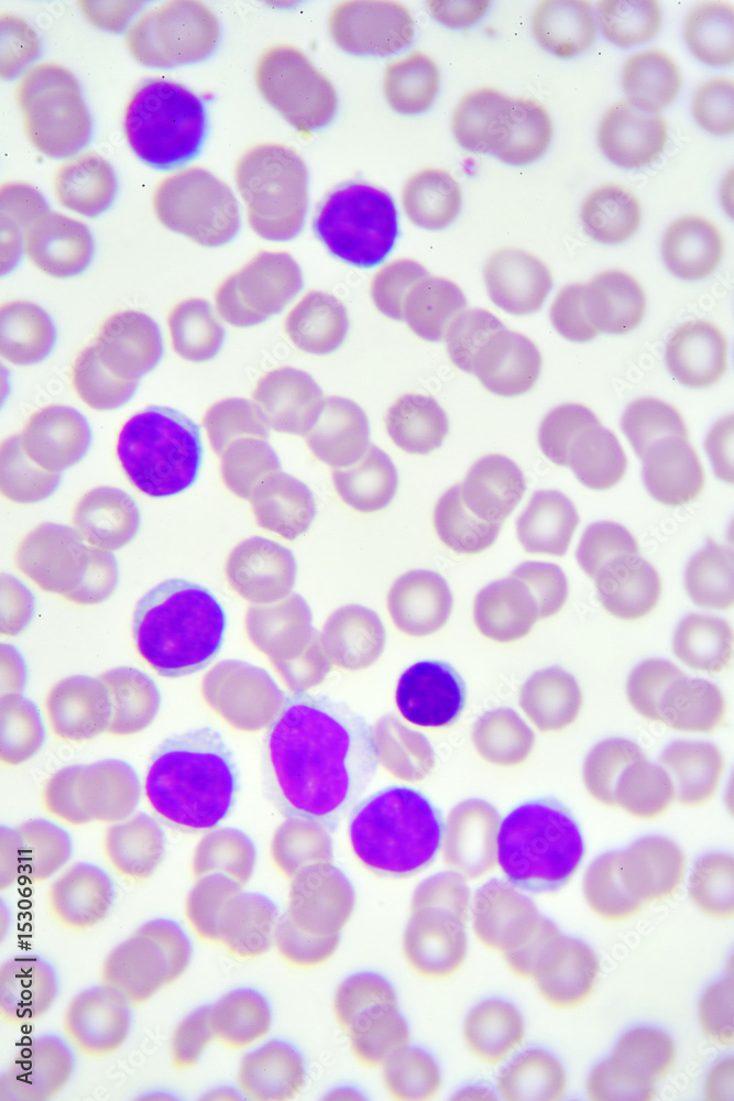 Leukemia cells in blood smear
Leukemia cells in blood smear