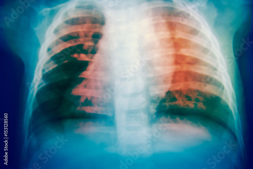 Close up bone  x-ray