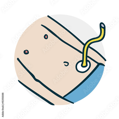 Special medical procedure on the intestine